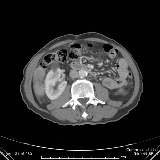 Calcified liver metastases (Radiopaedia 44699-48470 B 47).jpg
