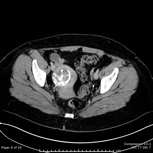 File:Calcified uterine fibroid (Radiopaedia 56077-62759 Axial C+ delayed 6).jpg