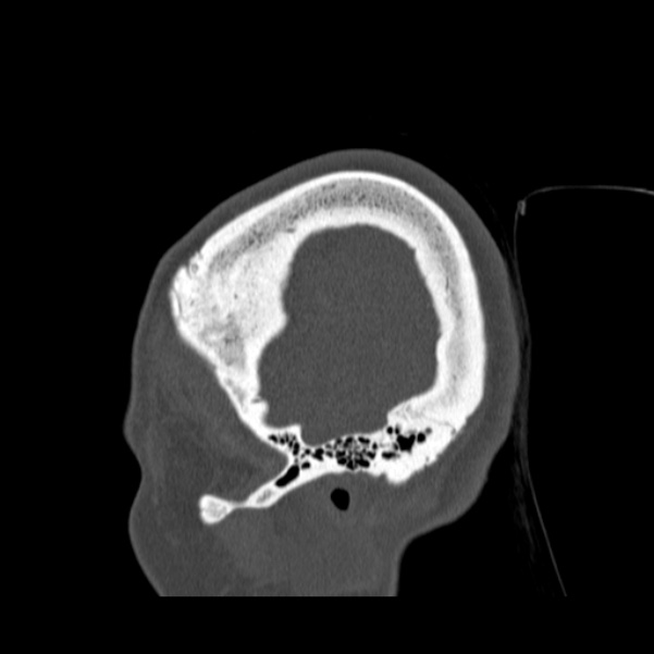 Calvarial osteoma (Radiopaedia 36520-38079 Sagittal bone window 96).jpg
