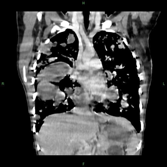 File:Cannon ball metastases - synovial sarcoma (Radiopaedia 26135-26271 Coronal liver window 7).jpg