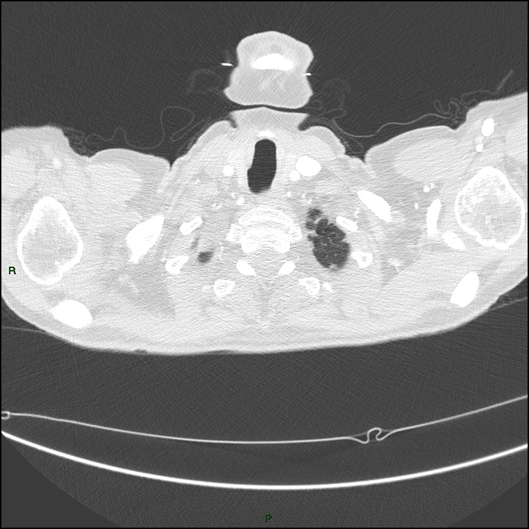 Cannonball metastases (Radiopaedia 82110-96150 Axial lung window 19).jpg