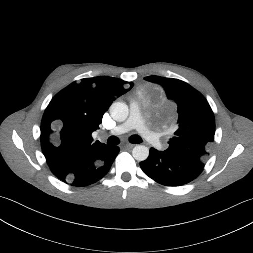 Cannonball metastases - testicular choriocarcinoma (Radiopaedia 84510-99891 B 53).jpg