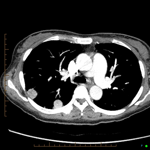 Canonball lung metastasis (Radiopaedia 77634-89837 B 36).jpg