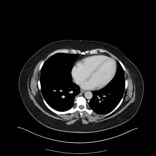 Carcinoid tumor - terminal ileum (Radiopaedia 60931-68739 A 4).jpg