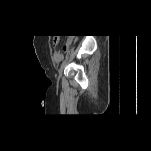 Carcinoma cervix- brachytherapy applicator (Radiopaedia 33135-34173 D 25).jpg