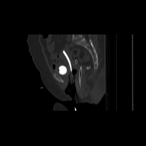 File:Carcinoma cervix- brachytherapy applicator (Radiopaedia 33135-34173 Sagittal bone window 85).jpg