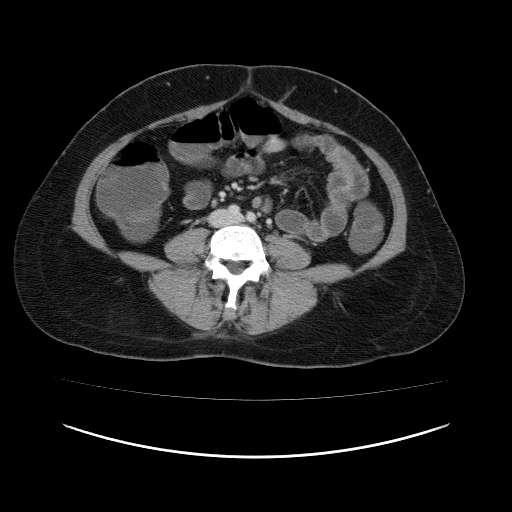 File:Carcinoma colon - hepatic flexure (Radiopaedia 19461-19493 A 76).jpg