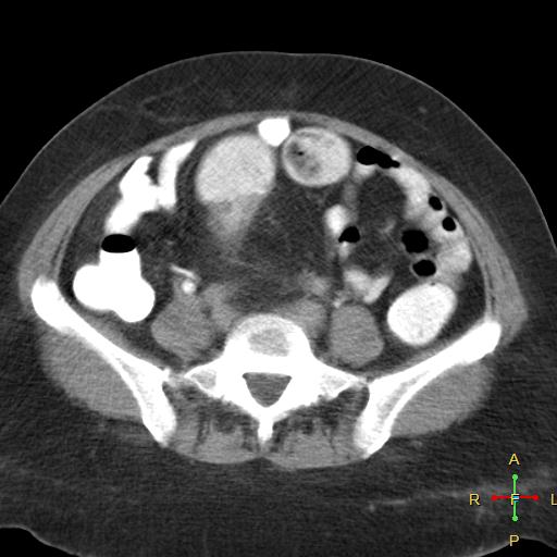 File:Carcinoma of sigmoid colon (Radiopaedia 23071-23100 C+ delayed 17).jpg