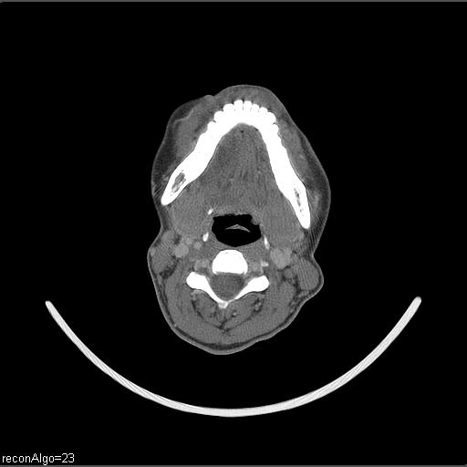 Carcinoma of the maxillary antrum (Radiopaedia 53805-59888 Axial C+ delayed 32).jpg
