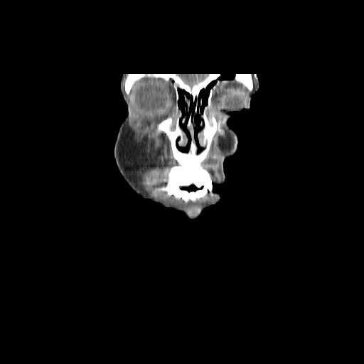 File:Carcinoma of the maxillary antrum (Radiopaedia 53805-59888 Coronal C+ delayed 14).jpg