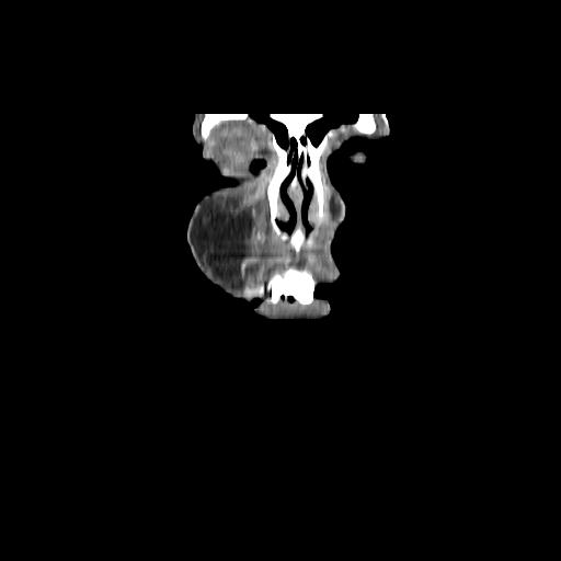 Carcinoma of the maxillary antrum (Radiopaedia 53805-59888 Coronal C+ delayed 8).jpg