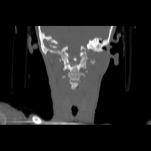 Carcinoma of the maxillary antrum (Radiopaedia 53805-59888 Coronal bone window 98).jpg