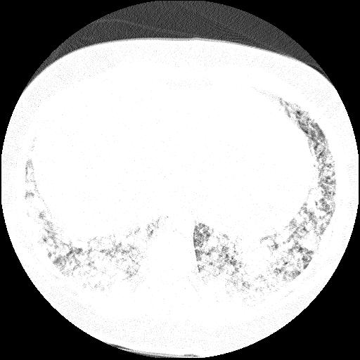 Cardiac angiosarcoma (Radiopaedia 66010-75181 Axial lung window 8).jpg