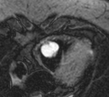 File:Cardiac hemangioma (Radiopaedia 31709-32631 Horizontal long axis 1).jpg