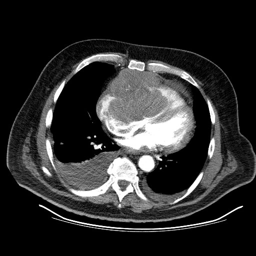 File:Cardiac lymphoma (Radiopaedia 38690-40836 Axial C+ CTPA 12).jpg