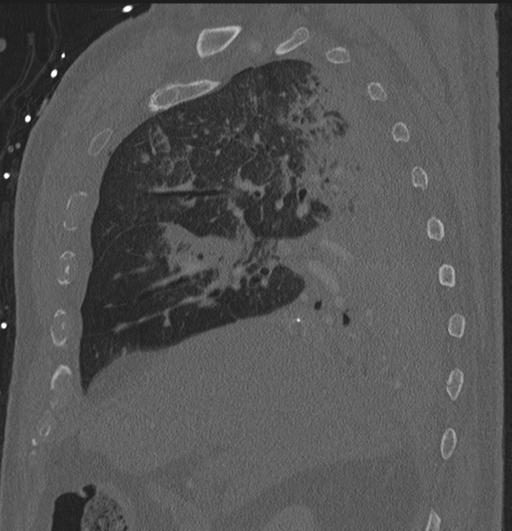 File:Cardiac trauma (Radiopaedia 32874-33858 Sagittal bone window 82).jpg