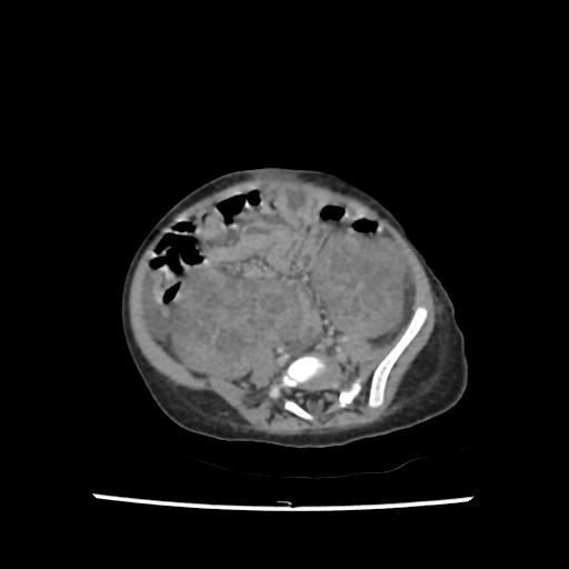 Caroli disease with autosomal recessive polycystic kidney disease (ARPKD) (Radiopaedia 89651-106703 B 163).jpg