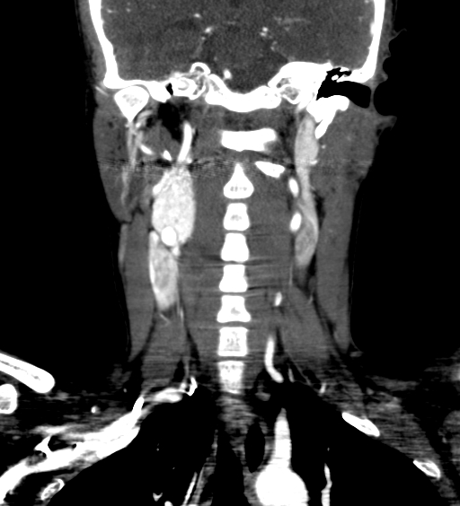 File:Carotid body tumor (Radiopaedia 39845-42300 C 46).jpg