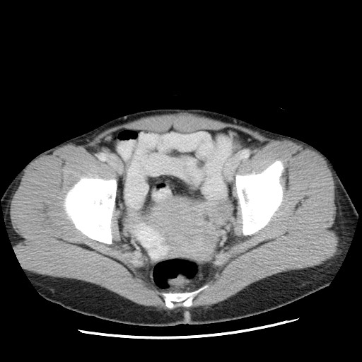 Castleman disease with fibrous pseudotumor in the abdomen (Radiopaedia 77296-89373 A 113).jpg