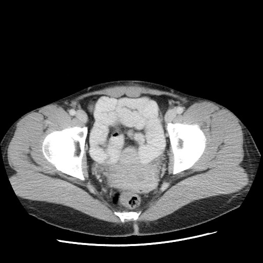 Castleman disease with fibrous pseudotumor in the abdomen (Radiopaedia 77296-89373 A 116).jpg