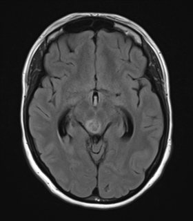 File:Cavernoma with bleed - midbrain (Radiopaedia 54546-60774 Axial FLAIR 14).png