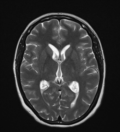File:Cavernoma with bleed - midbrain (Radiopaedia 54546-60774 Axial T2 14).png