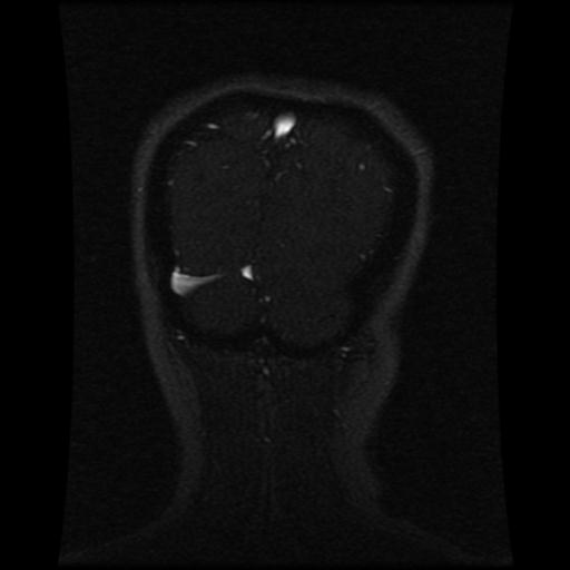 Cavernoma with developmental venous anomaly (Radiopaedia 22470-22507 MRV 32).jpg