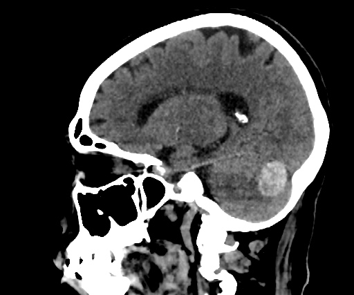 Cavernous hemangioma of the cerebellar falx (Radiopaedia 73025-83723 B 204).jpg