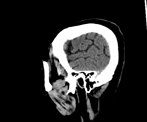 Cavernous hemangioma of the cerebellar falx (Radiopaedia 73025-83723 B 46).jpg