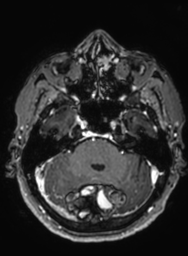 Cavernous hemangioma of the cerebellar falx (Radiopaedia 73025-83724 Axial T1 C+ 246).jpg