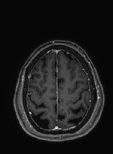 Cavernous hemangioma of the cerebellar falx (Radiopaedia 73025-83724 Axial T1 C+ 69).jpg