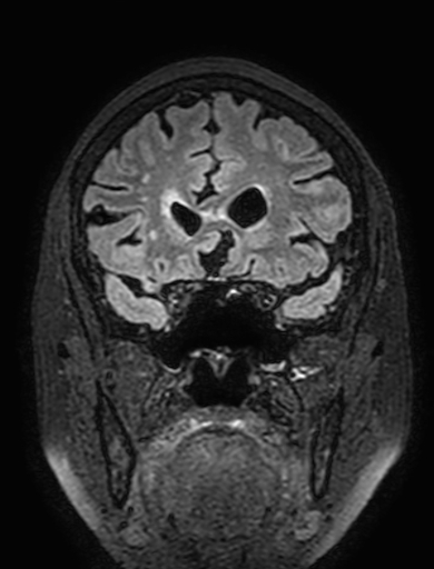 Cavernous hemangioma of the cerebellar falx (Radiopaedia 73025-83724 Coronal FLAIR 104).jpg