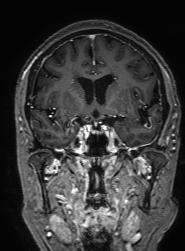 Cavernous hemangioma of the cerebellar falx (Radiopaedia 73025-83724 Coronal T1 C+ 157).jpg