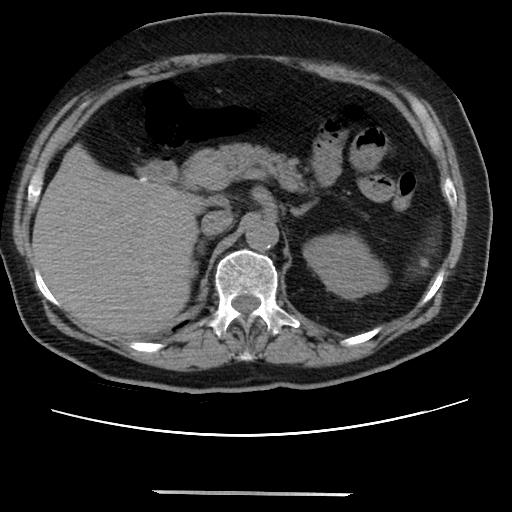 Cavitating pulmonary metastases (Radiopaedia 89545-106544 Axial non-contrast 59).jpg