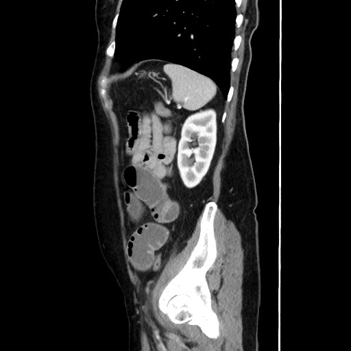 Cecal adenocarcinoma (Radiopaedia 75909-87331 C 54).jpg
