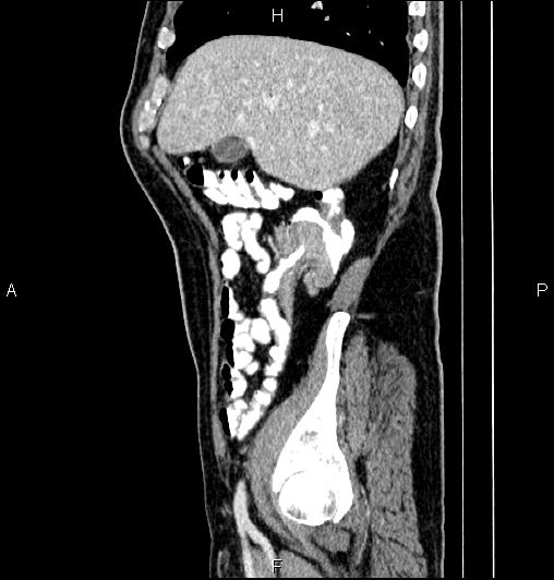 Cecal adenocarcinoma (Radiopaedia 85324-100916 E 20).jpg