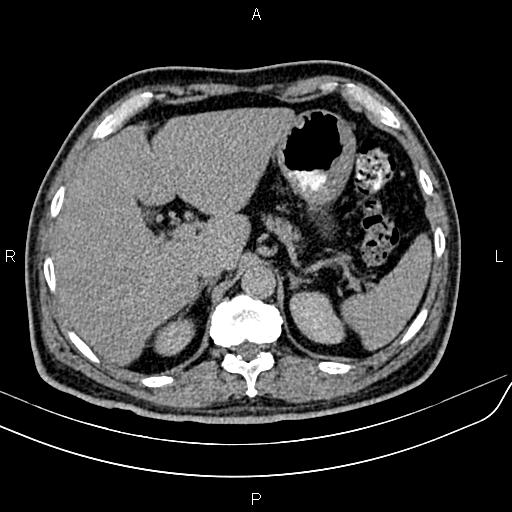 File:Cecal cancer with appendiceal mucocele (Radiopaedia 91080-108651 Axial C+ delayed 6).jpg