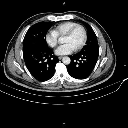 Cecal cancer with appendiceal mucocele (Radiopaedia 91080-108651 B 4).jpg