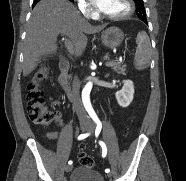 Celiac artery dissection (Radiopaedia 52194-58080 C 54).jpg