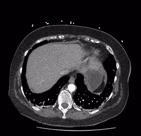 Celiac artery severe stenosis and dissection (Radiopaedia 44128-47842 B 4).jpg