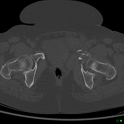 File:Central fracture-dislocation of the acetabulum (Radiopaedia 36578-38150 Axial bone window 70).jpg