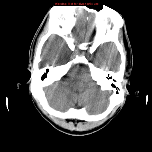 File:Central nervous system vasculitis (Radiopaedia 8410-9234 Axial non-contrast 6).jpg