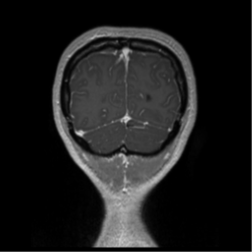 Central neurocytoma (Radiopaedia 37664-39557 Coronal T1 C+ 11).png