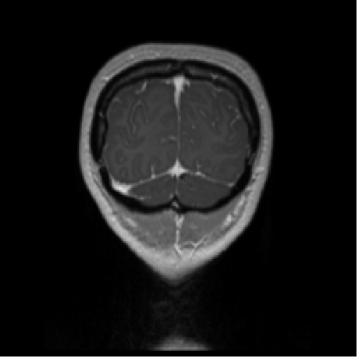 Central neurocytoma (Radiopaedia 37664-39557 Coronal T1 C+ 9).png