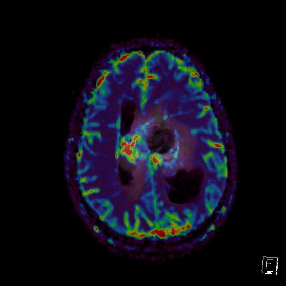 Central neurocytoma (Radiopaedia 84497-99872 Axial Perfusion 107).jpg