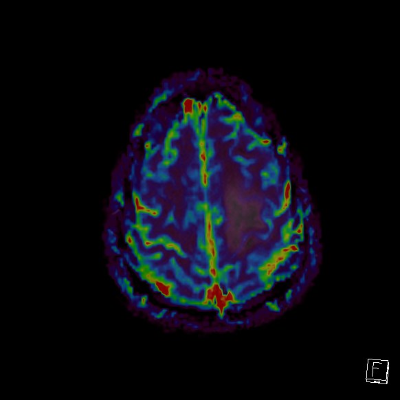 Central neurocytoma (Radiopaedia 84497-99872 Axial Perfusion 51).jpg