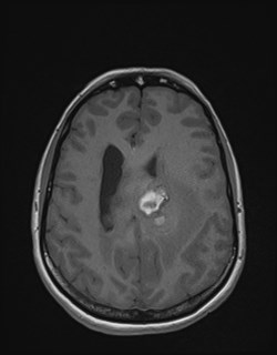 File:Central neurocytoma (Radiopaedia 84497-99872 Axial T1 133).jpg