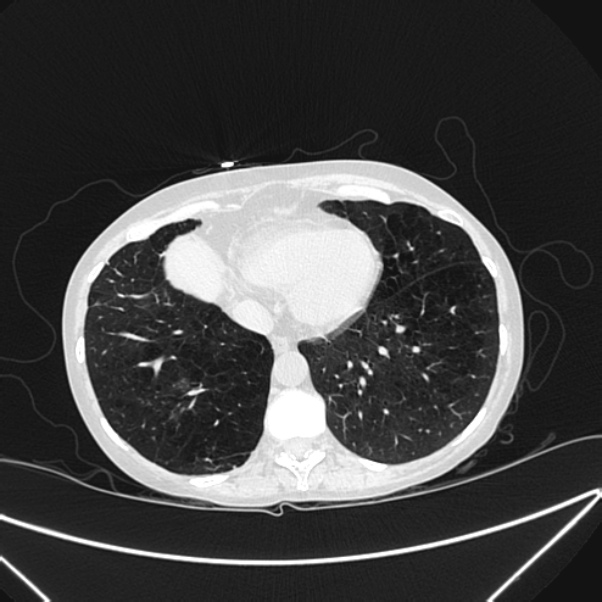 Centrilobular pulmonary emphysema (Radiopaedia 24495-24789 Axial lung window 72).jpg