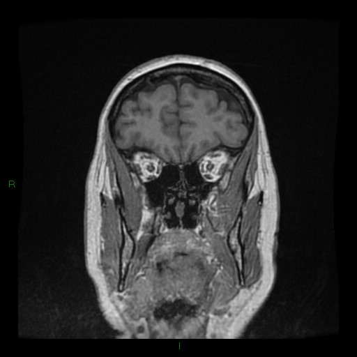Cerebellar abscess (Radiopaedia 78135-90678 Coronal T1 C+ 36).jpg