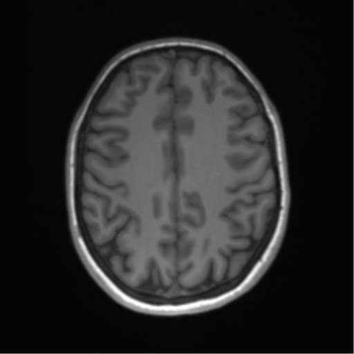 Cerebellar agenesis with hypoplastic pons (pontocerebellar hypoplasia) (Radiopaedia 57224-64138 Axial T1 54).png